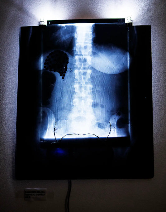 Elisabette Zelaya : Femme au stérilet